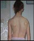 Scoliosis Before Bowen